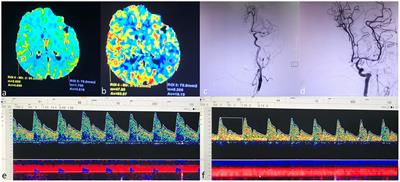 A Prospective Study to Investigate Controlling Blood Pressure Under Transcranial Doppler After Endovascular Treatment in Patients With Occlusion of Anterior Circulation